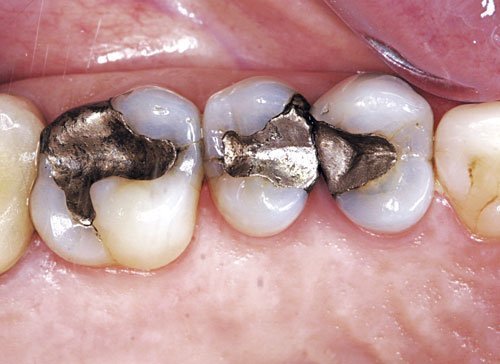 Dental Aesthetics Amalgam | DR. HAGER