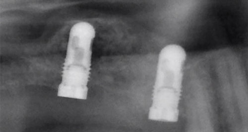 Vergleich - Roentgen - Implantate - Knochenaufbau - Zahnimplantate