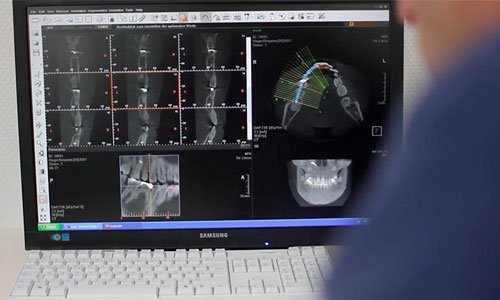 3D Röntgenbild auf Computerbildschirm für Navigierte Implantation 