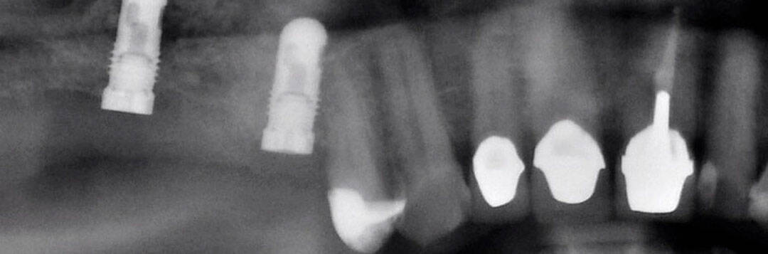 Navigated implantation X-ray with dental implants