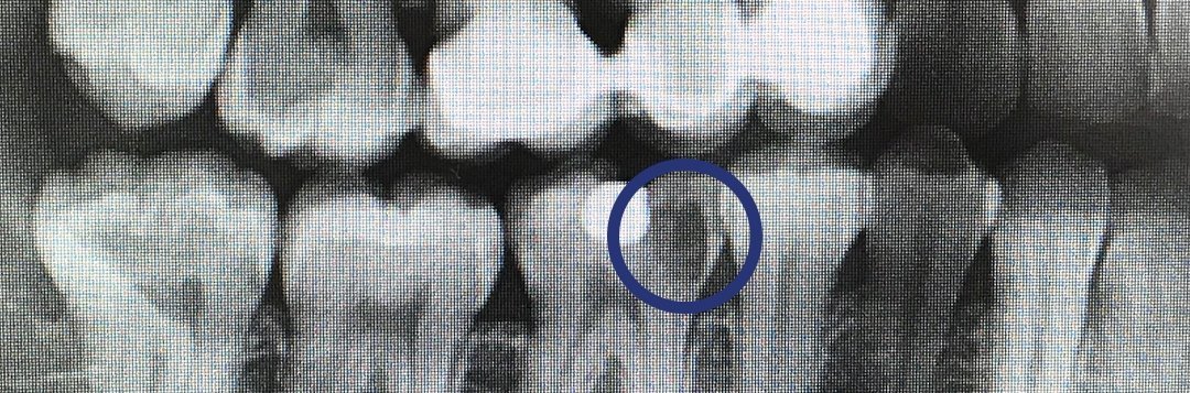 Röntgenbild mit eingekreistem Kariesbefall im Zahnzwischenraum