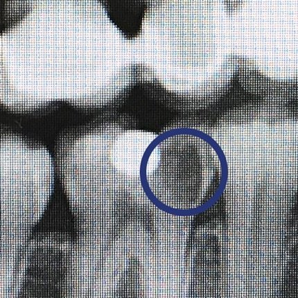 Röntgenbild mit eingekreistem Kariesbefall im Zahnzwischenraum