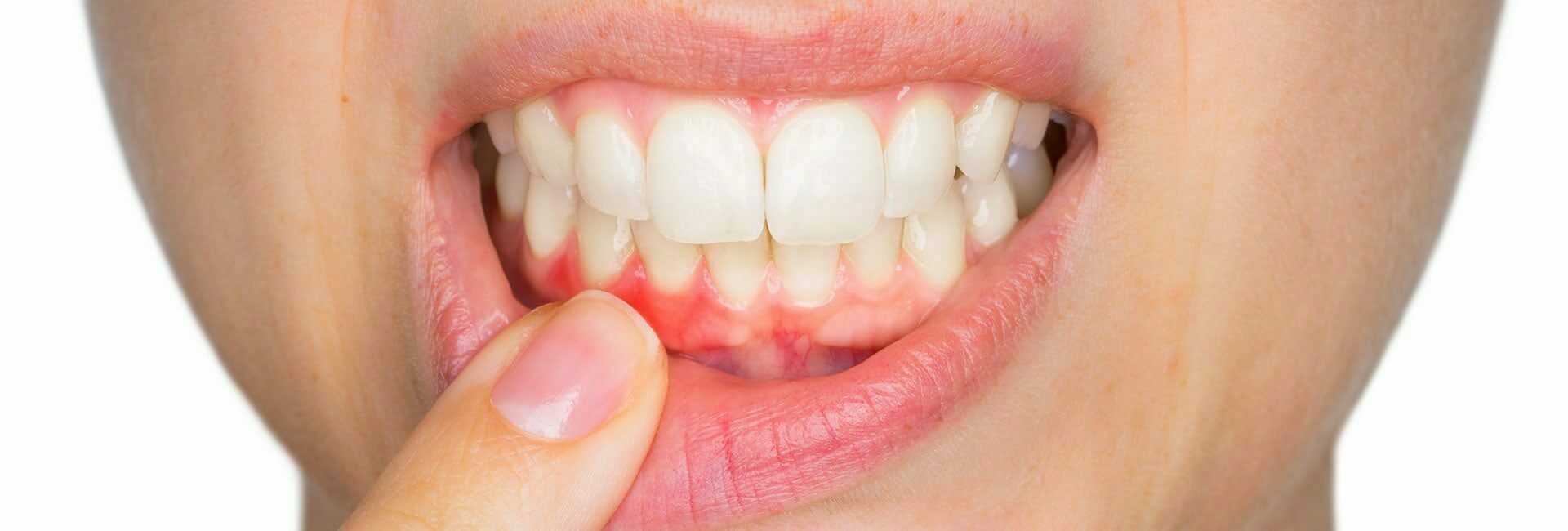 Frau zeigt mit Finger auf ihre Zahnfleischentzündung