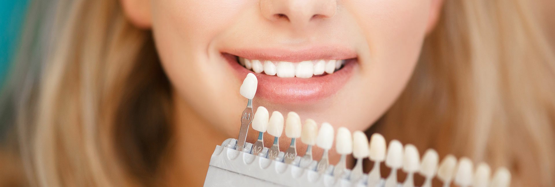 bei lächelnder Patientin wird die richtige Zahnfarbe mit einer Zahnfarben-Tabelle bestimmt 