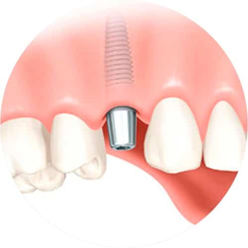 Implant for one tooth