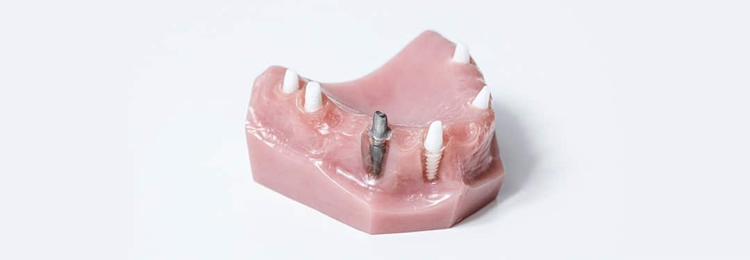 A mandibular denture with titanium and ceramic implants.
