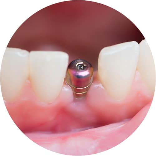 Immediate restoration with a dental implant
