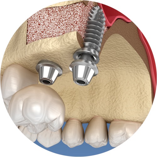 Gebiss Ansicht nach dem Knochenaufbau mit zwei Implantaten und einer Zahnkrone