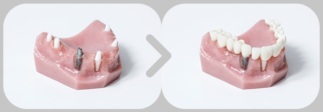 Künstlicher Kiefer mit Zahnimplantat
